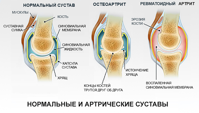 Уход при суставных болях лфк на лучезапястном суставе